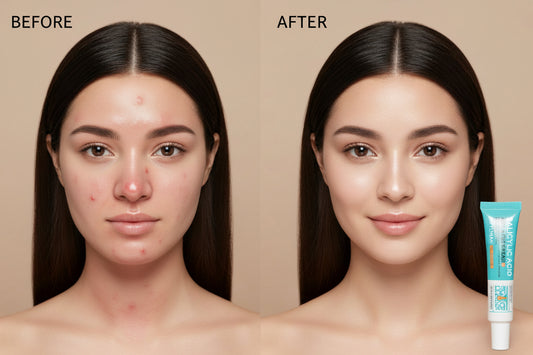 Salicylic Acid Acne Removal Cream – Anti-Acne & Redness Repair